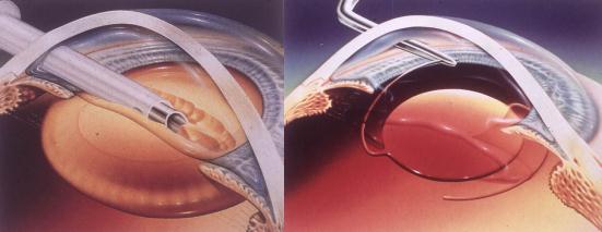 白內障,希瑪瑞視眼科,上海眼科醫(yī)院 白內障,希瑪瑞視眼科,上海眼科醫(yī)院