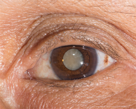 白內(nèi)障,希瑪瑞視眼科,上海眼科醫(yī)院 白內(nèi)障,希瑪瑞視眼科,上海眼科醫(yī)院