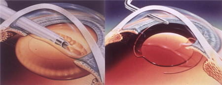 白內(nèi)障,希瑪瑞視眼科,上海眼科醫(yī)院 白內(nèi)障,希瑪瑞視眼科,上海眼科醫(yī)院