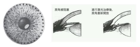 青光眼,?，斎鹨曆劭?上海眼科醫院