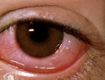 眼表眼角膜,希瑪瑞視眼科,上海眼科醫(yī)院