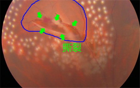 玻璃體視網膜,希瑪瑞視眼科,上海眼科醫院
