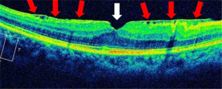 玻璃體視網膜,希瑪瑞視眼科,上海眼科醫院 玻璃體視網膜,希瑪瑞視眼科,上海眼科醫院