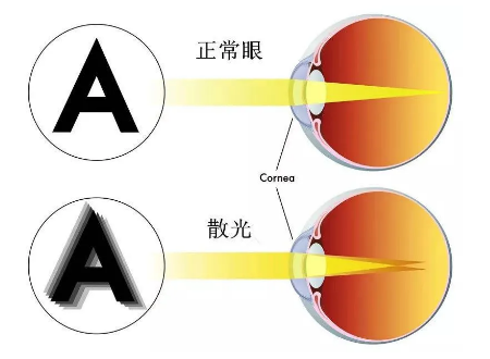 屈光矯視,希瑪瑞視眼科,上海眼科醫院