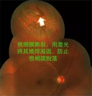 玻璃體視網(wǎng)膜,希瑪瑞視眼科,上海眼科醫(yī)院 玻璃體視網(wǎng)膜,希瑪瑞視眼科,上海眼科醫(yī)院