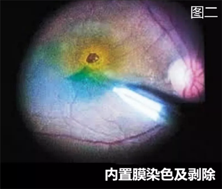 玻璃體視網(wǎng)膜,希瑪瑞視眼科,上海眼科醫(yī)院