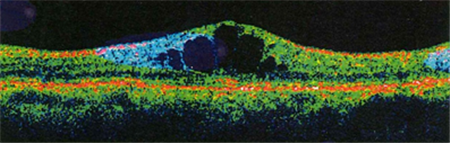 玻璃體視網(wǎng)膜,希瑪瑞視眼科,上海眼科醫(yī)院