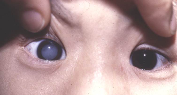 白內障,希瑪瑞視眼科,上海眼科醫院