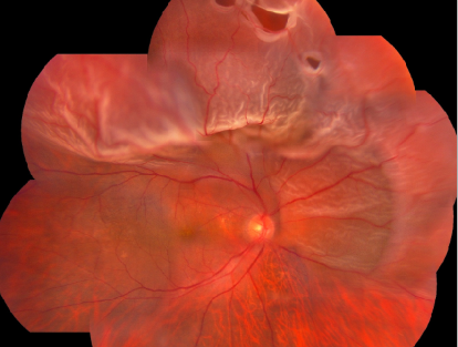 玻璃體視網膜,希瑪瑞視眼科,上海眼科醫院