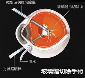 玻璃體視網膜,希瑪瑞視眼科,上海眼科醫院