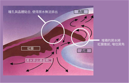 青光眼,希瑪瑞視眼科,上海眼科醫院