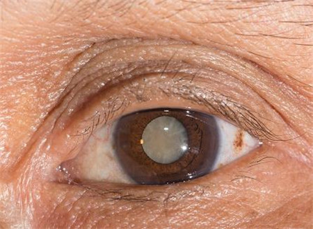 白內障,希瑪瑞視眼科,上海眼科醫院