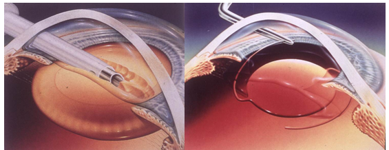 青光眼,希瑪瑞視眼科,上海眼科醫院