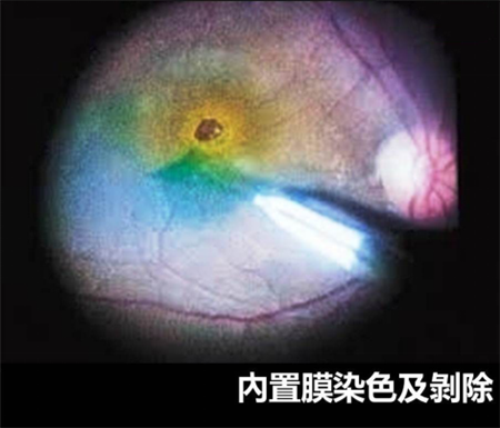 玻璃體視網膜,希瑪瑞視眼科,上海眼科醫院 玻璃體視網膜,希瑪瑞視眼科,上海眼科醫院