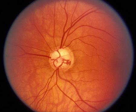 青光眼,希瑪瑞視眼科,上海眼科醫院