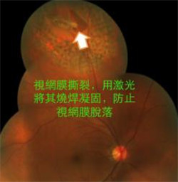 玻璃體視網膜,希瑪瑞視眼科,上海眼科醫院