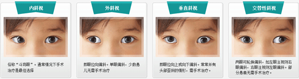 小兒眼病,希瑪瑞視眼科,上海眼科醫院