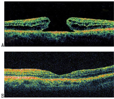 玻璃體視網膜,希瑪瑞視眼科,上海眼科醫院