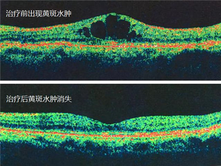玻璃體視網膜,?，斎鹨曆劭?上海眼科醫院