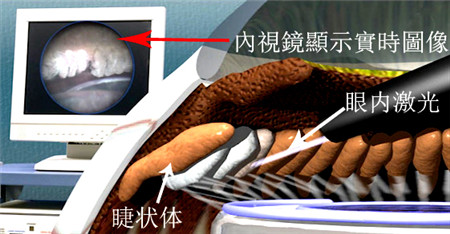 青光眼,希瑪瑞視眼科,上海眼科醫院