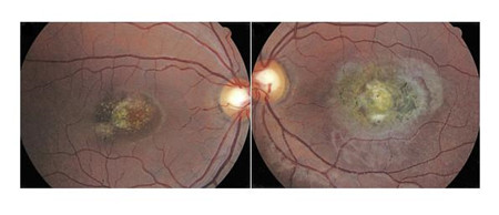 小兒眼病,希瑪瑞視眼科,上海眼科醫院 小兒眼病,希瑪瑞視眼科,上海眼科醫院