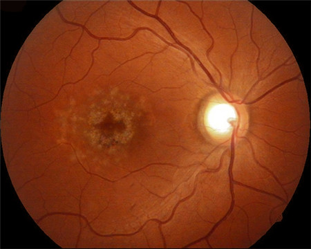 玻璃體視網膜,希瑪瑞視眼科,上海眼科醫院