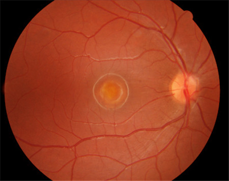 玻璃體視網膜,希瑪瑞視眼科,上海眼科醫院