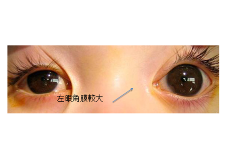 青光眼,希瑪瑞視眼科,上海眼科醫院 青光眼,希瑪瑞視眼科,上海眼科醫院