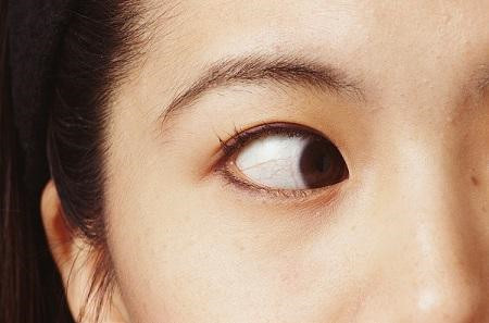 小兒眼病,希瑪瑞視眼科,上海眼科醫院