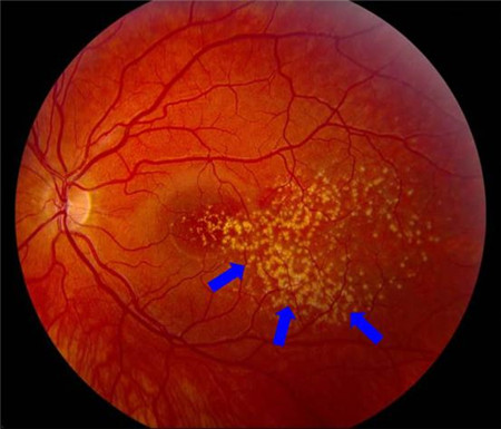 玻璃體視網(wǎng)膜,?，斎鹨曆劭?上海眼科醫(yī)院
