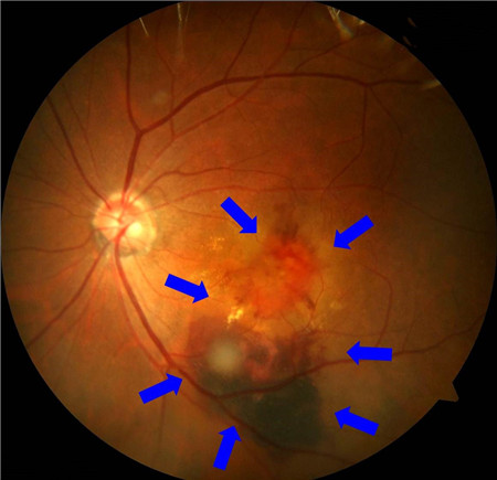 玻璃體視網(wǎng)膜,希瑪瑞視眼科,上海眼科醫(yī)院