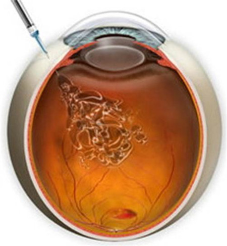 玻璃體視網(wǎng)膜,?，斎鹨曆劭?上海眼科醫(yī)院