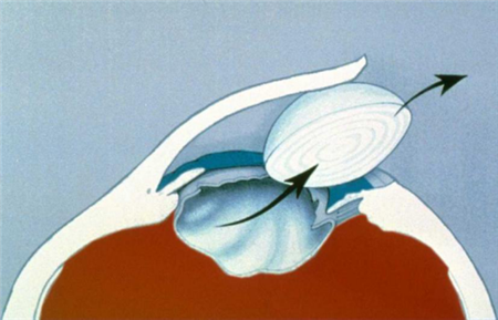 白內障,希瑪瑞視眼科,上海眼科醫院