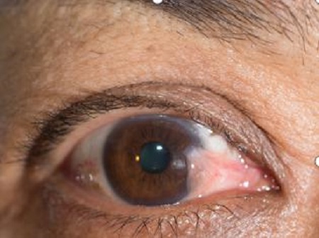 眼表眼角膜,?，斎鹨曆劭?上海眼科醫院