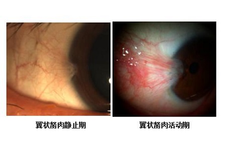 眼表眼角膜,?，斎鹨曆劭?上海眼科醫院