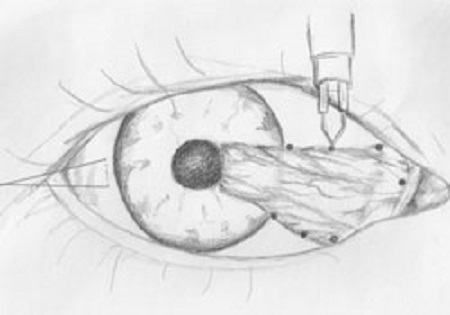 眼表眼角膜,?，斎鹨曆劭?上海眼科醫院