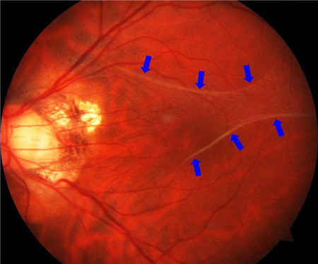 玻璃體視網膜,希瑪瑞視眼科,上海眼科醫(yī)院 玻璃體視網膜,希瑪瑞視眼科,上海眼科醫(yī)院