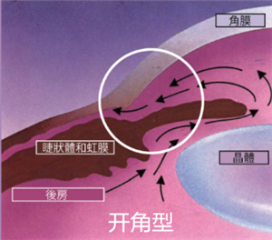 青光眼,希瑪瑞視眼科,上海眼科醫院