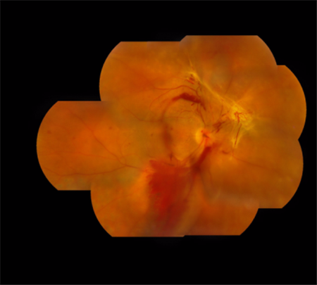 玻璃體視網(wǎng)膜,?，斎鹨曆劭?上海眼科醫(yī)院