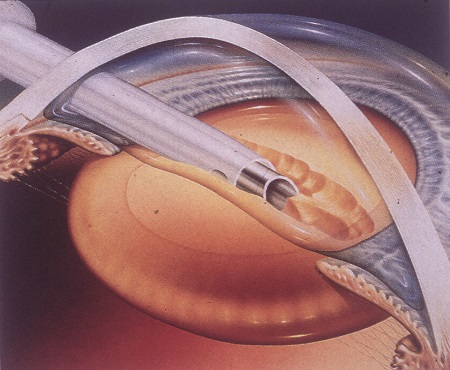 白內障,?，斎鹨曆劭?上海眼科醫院