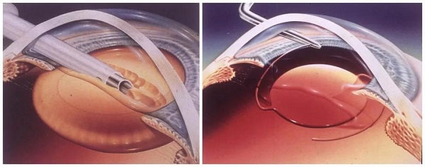 白內障,?，斎鹨曆劭?上海眼科醫院