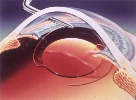 白內障,?，斎鹨曆劭?上海眼科醫院