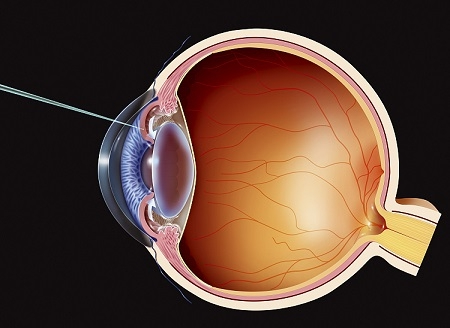 青光眼,?，斎鹨曆劭?上海眼科醫院