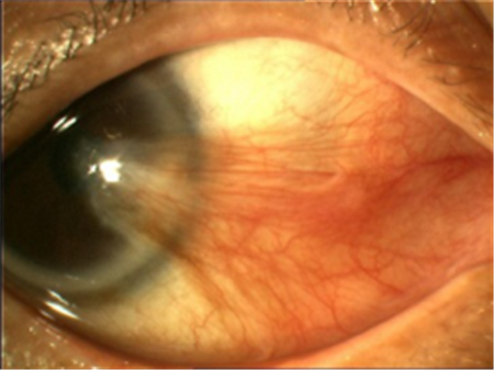 眼表眼角膜,希瑪瑞視眼科,上海眼科醫院