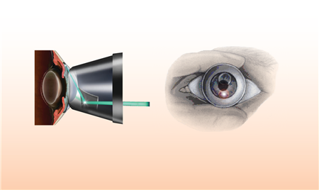 青光眼,希瑪瑞視眼科,上海眼科醫(yī)院 青光眼,希瑪瑞視眼科,上海眼科醫(yī)院