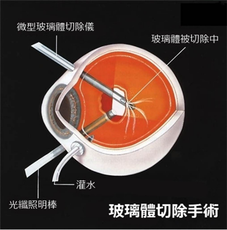 玻璃體視網膜,希瑪瑞視眼科,上海眼科醫院