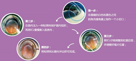 屈光矯視,希瑪瑞視眼科,上海眼科醫(yī)院