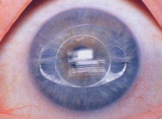 屈光矯視,希瑪瑞視眼科,上海眼科醫(yī)院