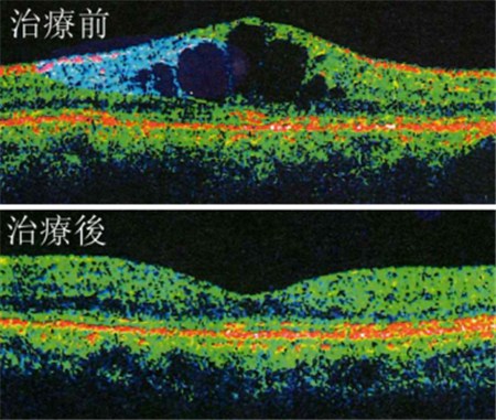 玻璃體視網膜,希瑪瑞視眼科,上海眼科醫(yī)院