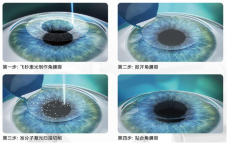 屈光矯視,希瑪瑞視眼科,上海眼科醫院